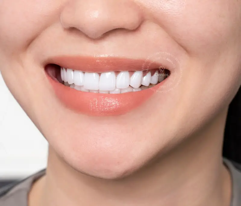 Răng sứ DDBio có tốt không và cách nhận biết sứ chính hãng